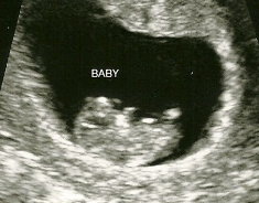 A black and white 2D ultrasound. 